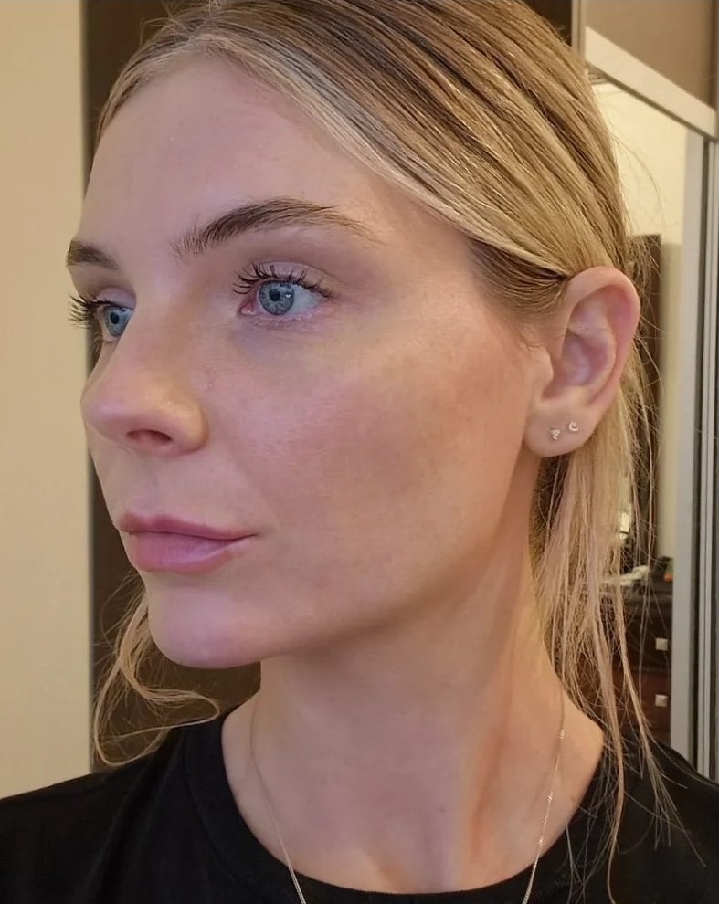 Close-up skin treatment result by Little Beauty Secrets