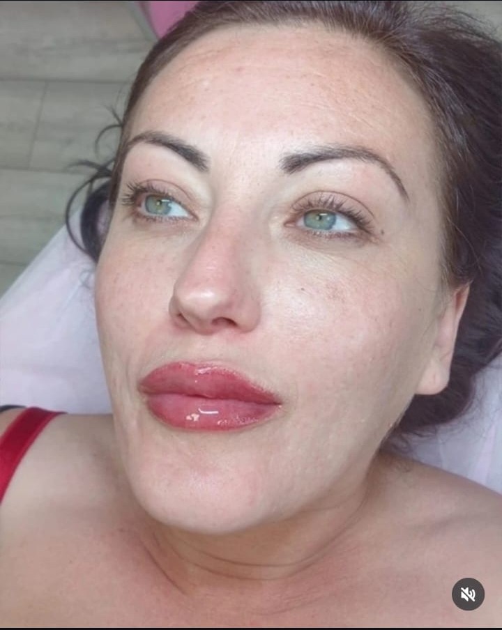 Recent beauty treatment result by Little Beauty Secrets